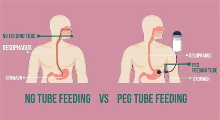 Are PEG tubes safe