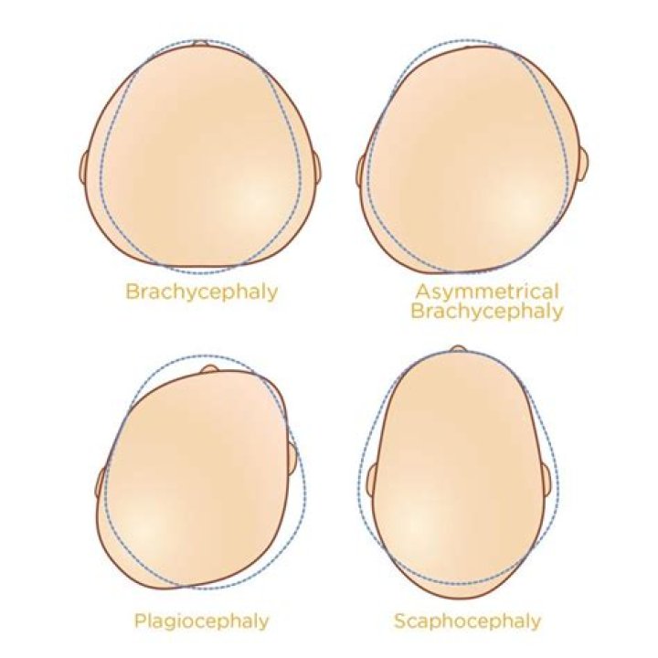 Can plagiocephaly be corrected