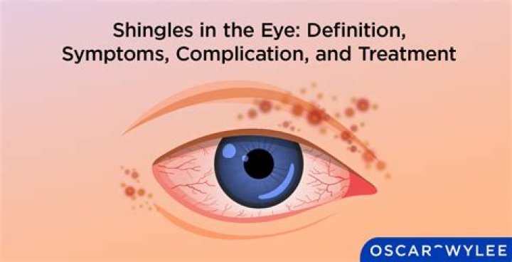 Can shingles start on eyelid
