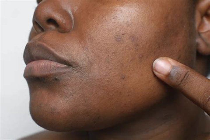 Do age spots increase in size?