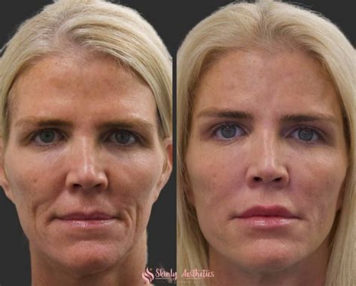 Do fillers work on deep wrinkles?