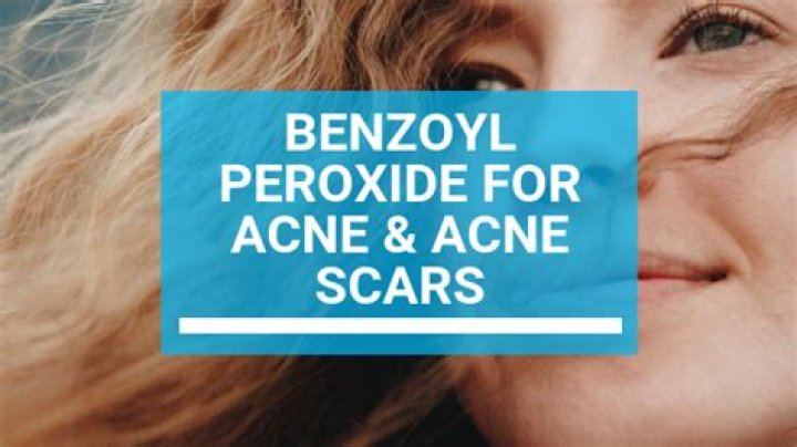 Does benzoyl peroxide help acne