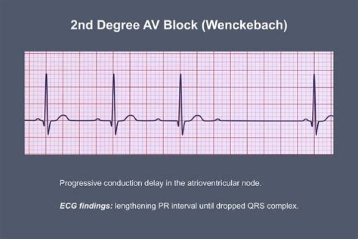 Does second-degree heart block need treatment?