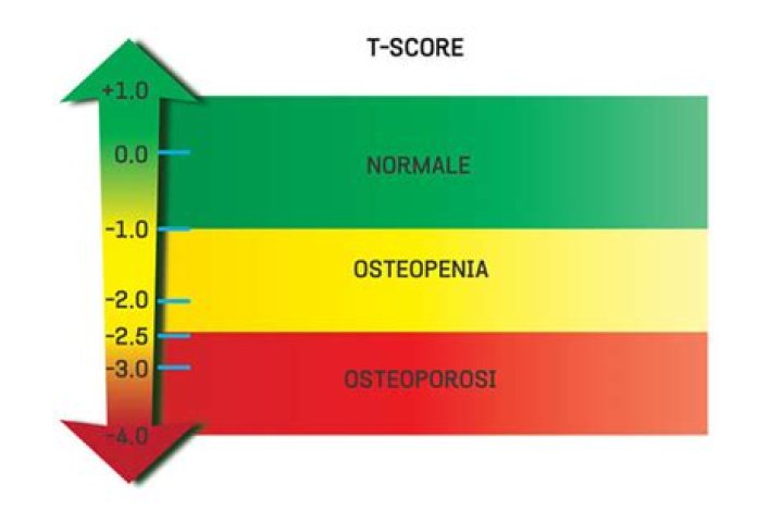 How bad is a T-score for bone density?