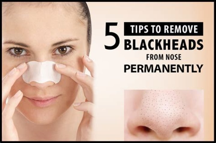 How can I remove blackheads?