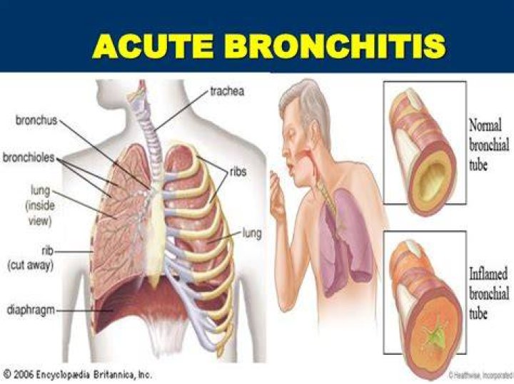 How did I get bronchitis?