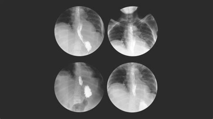 How do I prepare for an upper GI
