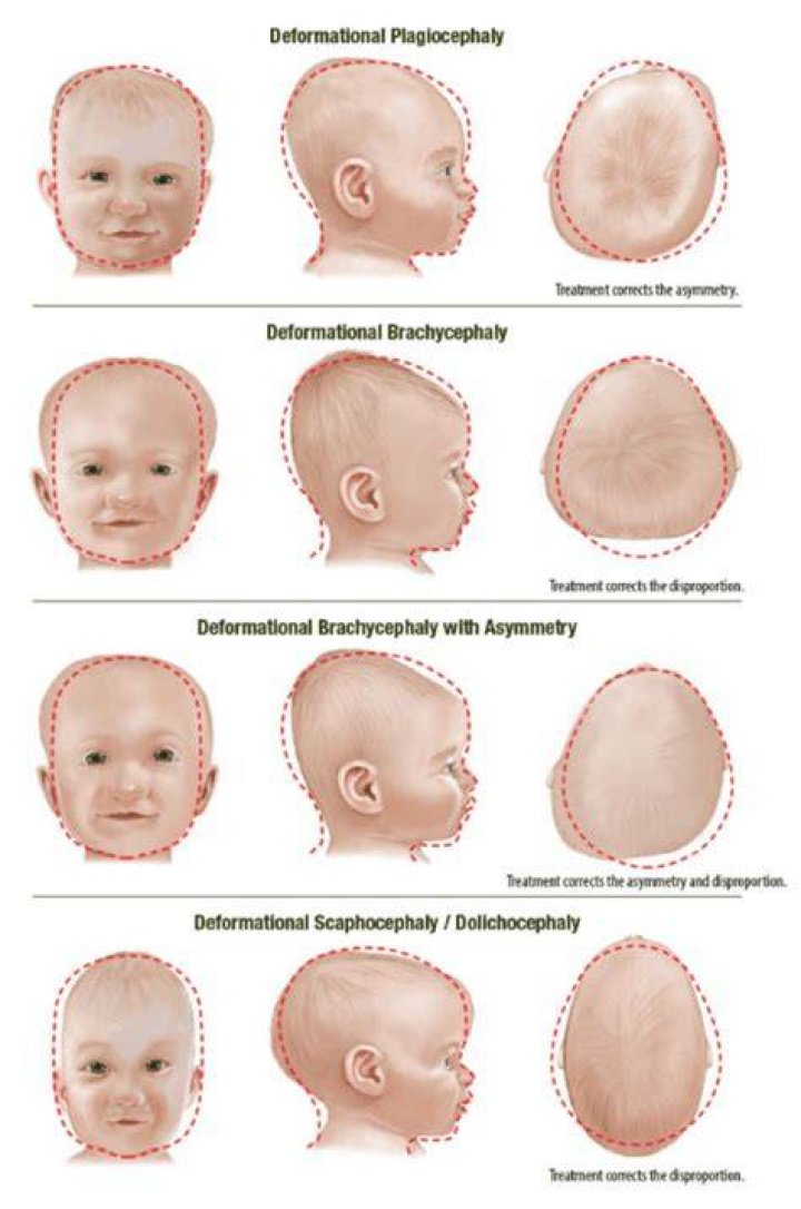 How do you fix Scaphocephaly?