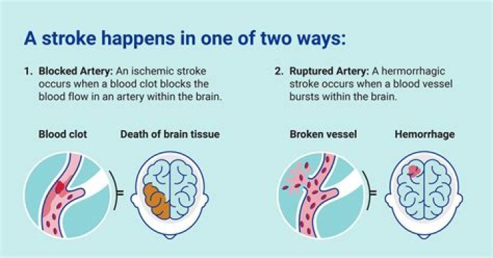 How does a stroke affect you mentally