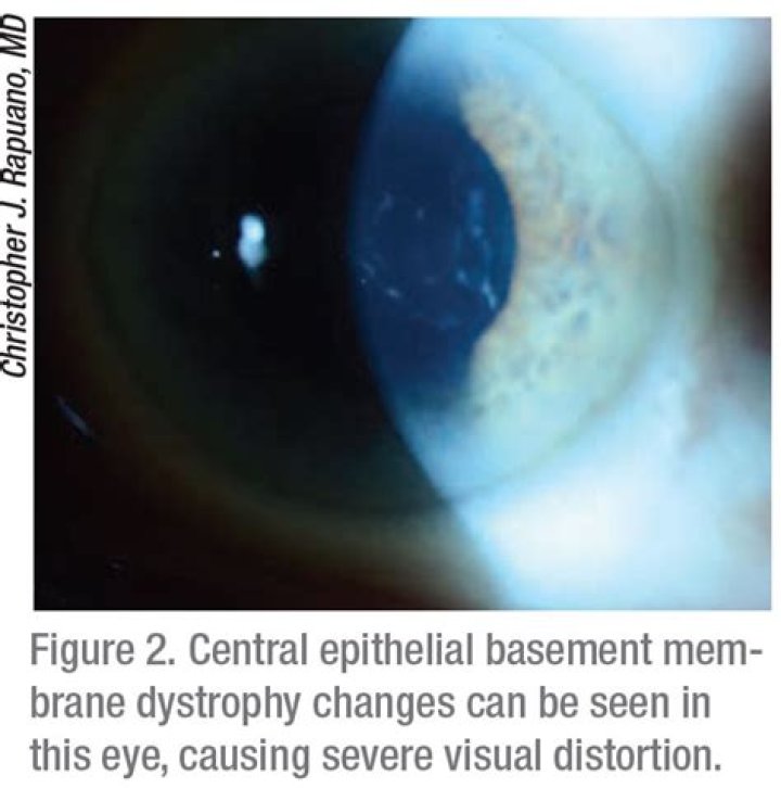 How is EBMD treated