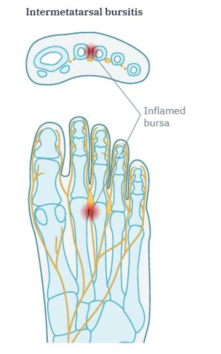 How is Intermetatarsal bursitis treated?