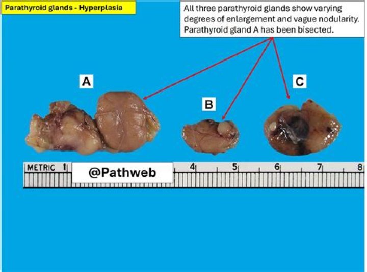 How is parathyroid hyperplasia treated?