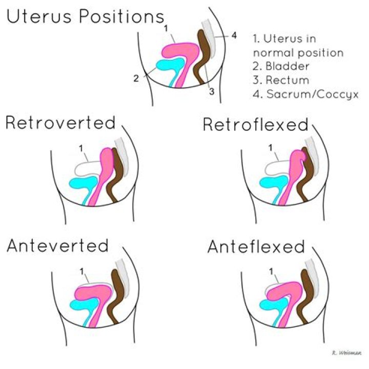 How is Retroverted uterus corrected