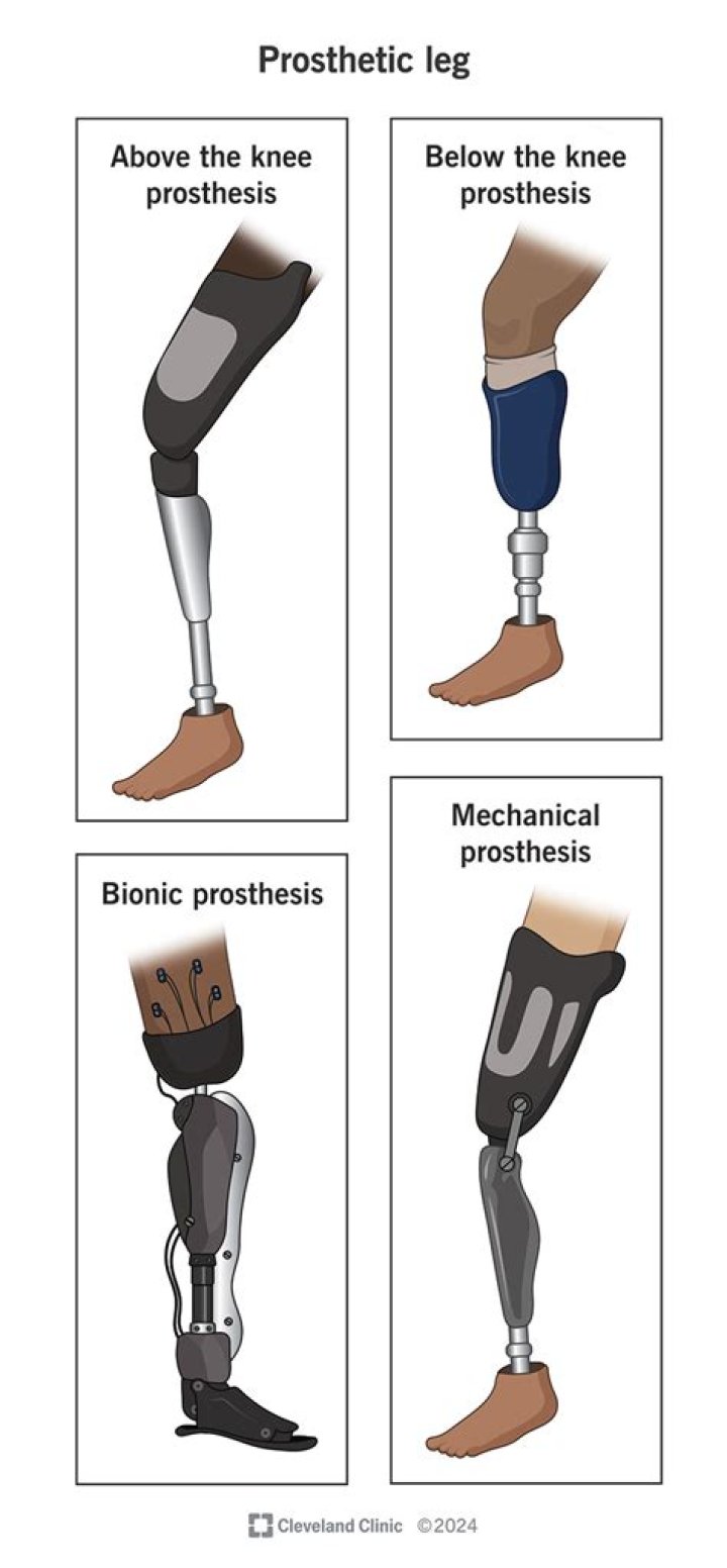 How much does a prosthesis cost