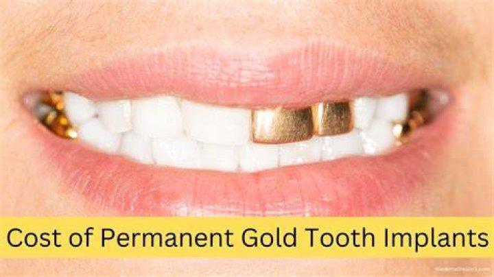 How much should gold teeth cost?