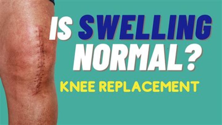 Is ankle swelling normal after hip replacement?