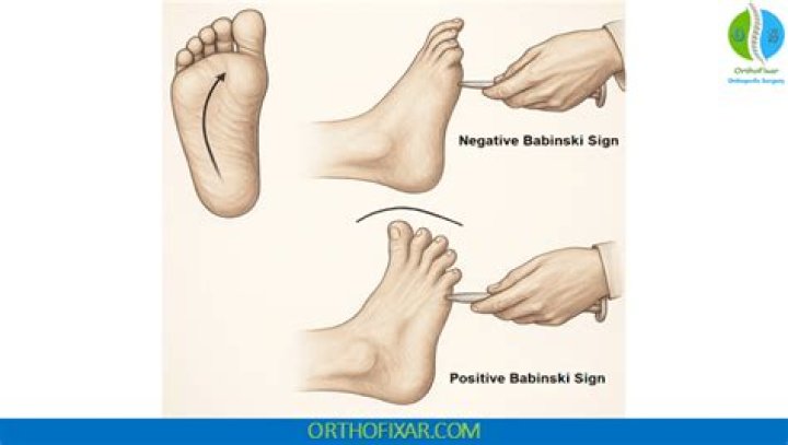 Is Babinski positive or negative