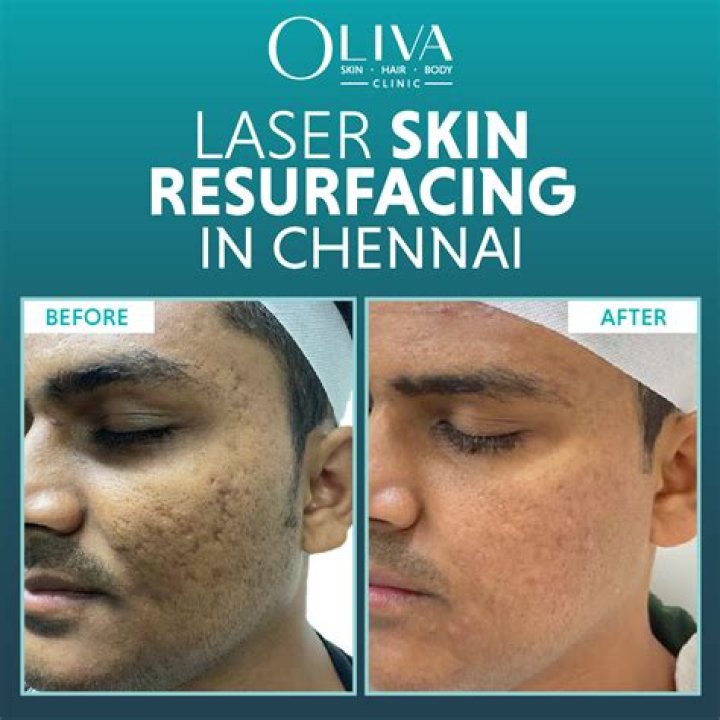 Is K Laser Effective