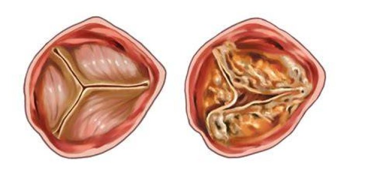 O que e esclerose valvar mitral e aortica?