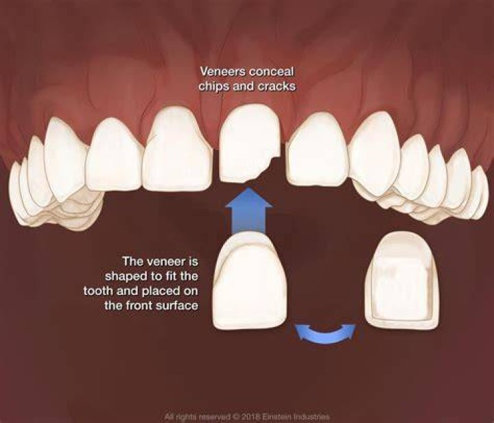 On which tooth surface is a veneer placed