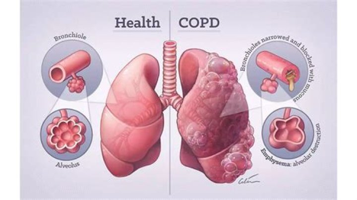 What 3 diseases make up COPD?