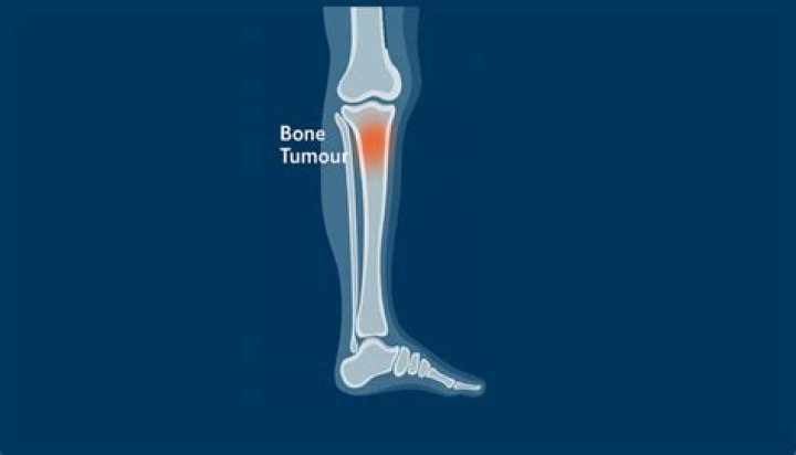 What are bone Tumours?