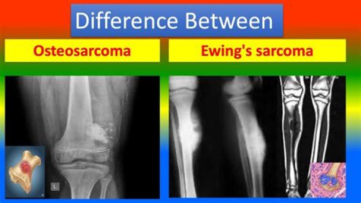 What can mimic osteosarcoma?