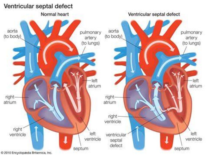 What causes a ventricular gallop?