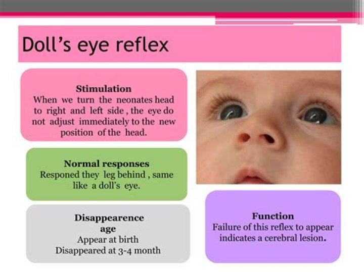 What causes dolls eye reflex