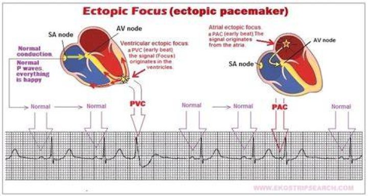 What causes ectopic focus