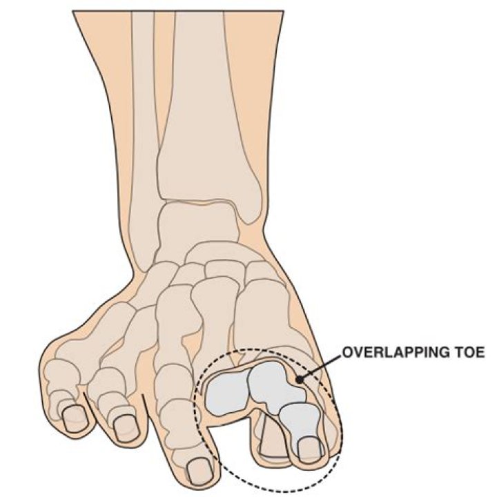What causes lesser toe deformities?