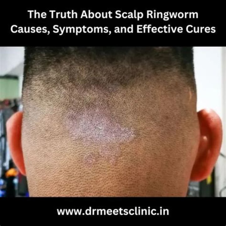 What causes ringworms on the head