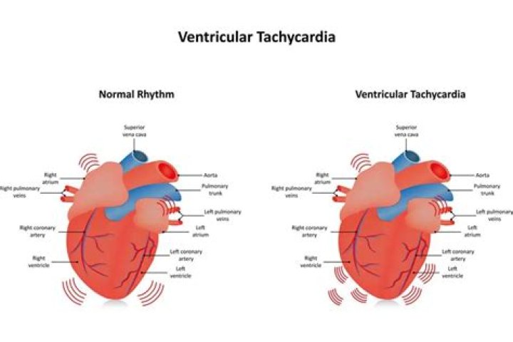 What causes ventricular gallop
