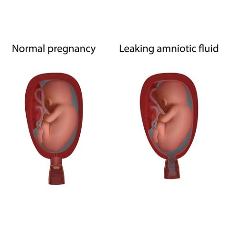What does amniotic fluid consist of