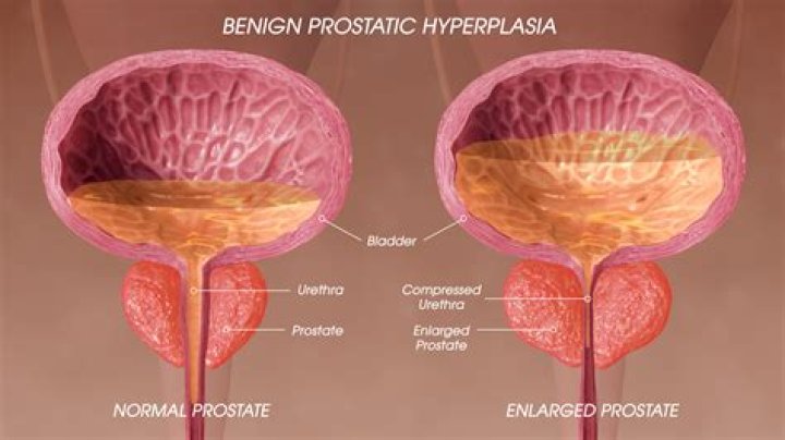 What does benign mean in prostate?