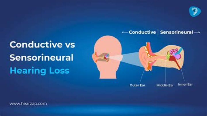 What does bilateral sensorineural hearing loss mean?