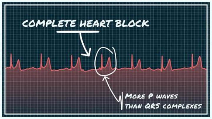 What does complete heart block mean?