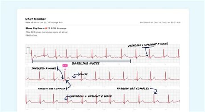 What does PAC mean on ECG