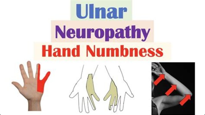 What does ulnar neuropathy mean
