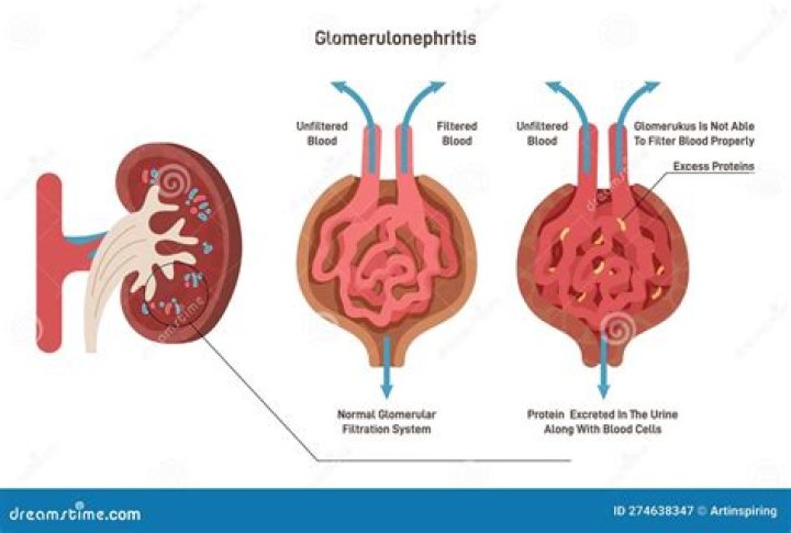 What is a glomerulonephritis