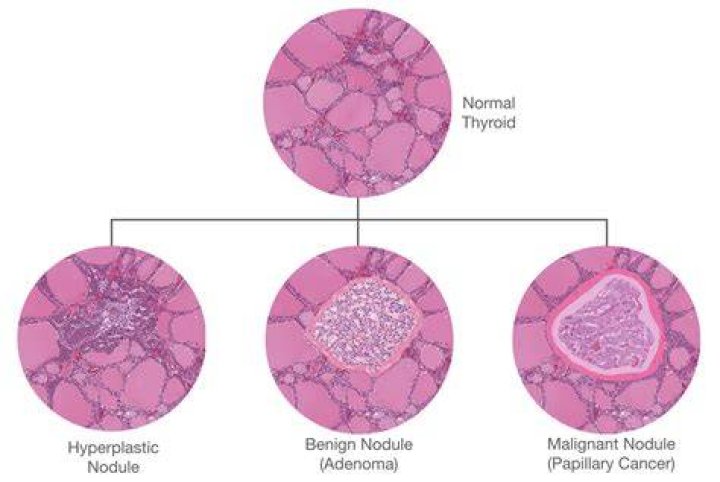 What is a hyperplastic nodule
