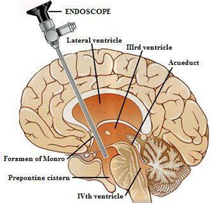 What is an ETV procedure