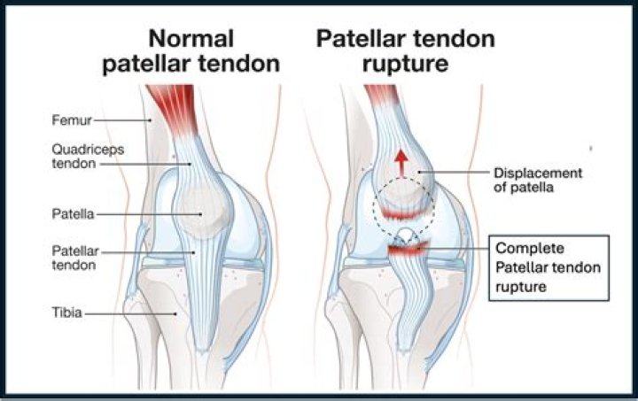 What is an intermediate tendon