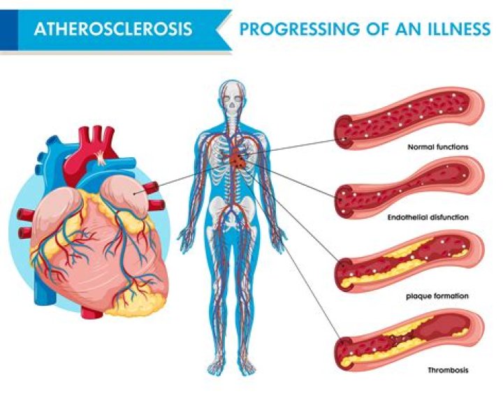 What is Arteriolosclerosis
