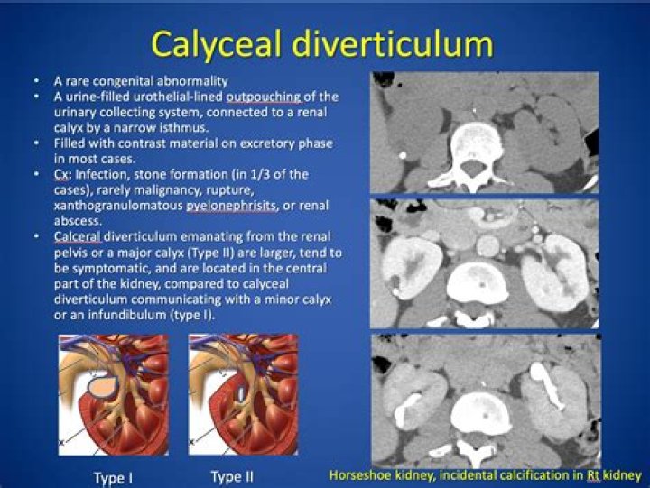 What is Calyceal