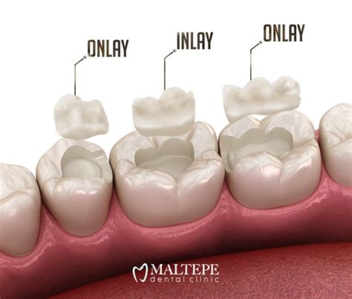 What is composite onlay
