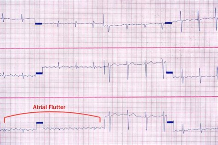 What is heart aflutter?