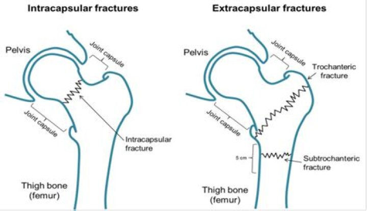 What is intracapsular vs extracapsular?