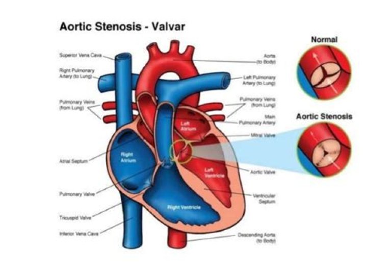 What is left ventricular outflow obstruction?