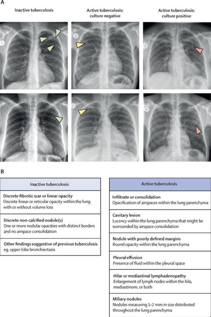 What is non active TB called?